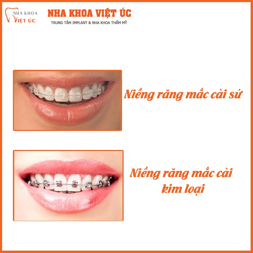 Niềng răng mắc cài sứ giá bao nhiêu phụ thuộc vào tình trạng răng của bạn.