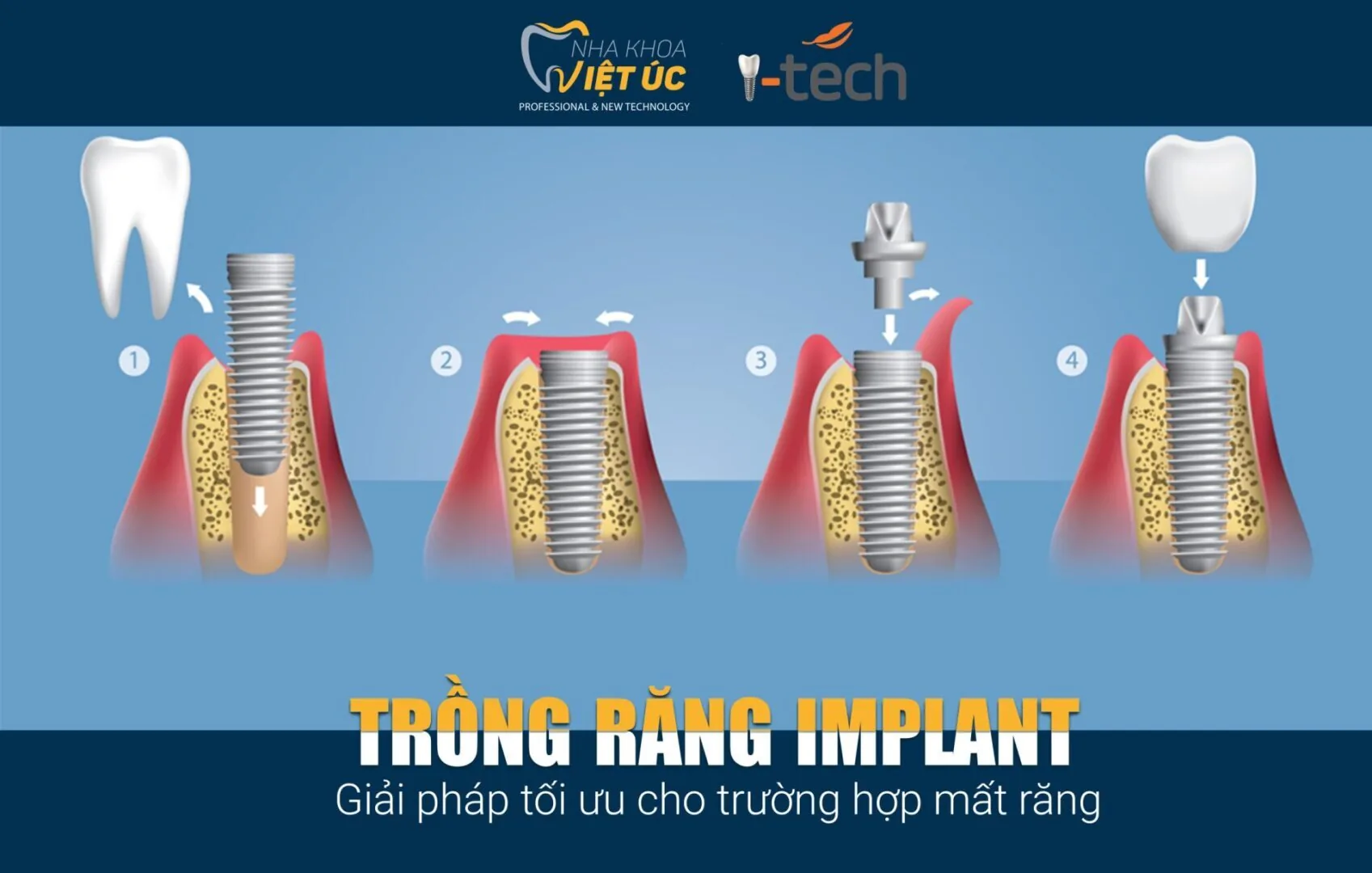 trong rang Implant giai phap toi uu cho nguoi mat rang