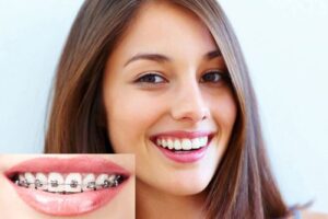 Thời gian niềng răng bao lâu phụ thuộc vào yếu tố nào?