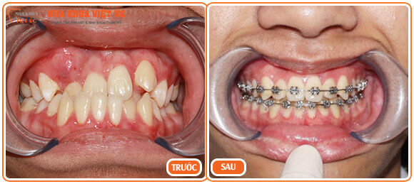 Hình ảnh bệnh nhân niềng răng móm bằng mắc cài kim loại