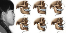 Khi nào niềng răng móm cần kết hợp với phẫu thuật tạo hình?