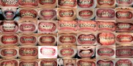 Răng xinh lung linh – Rinh quà siêu khủng