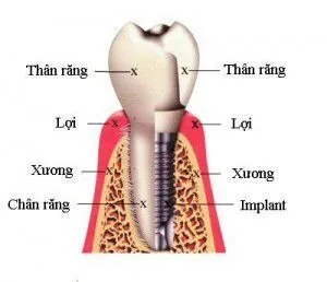 cay ghep implant an toan tai nha khoa Viet uc 0 cay ghep implant an toan tai nha khoa Viet uc 0