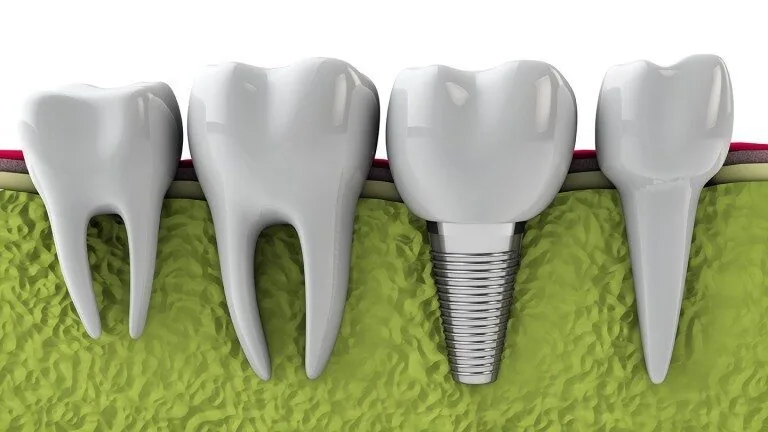 cay ghep implant an toan tai nha khoa Viet uc 1 cay ghep implant an toan tai nha khoa Viet uc 1