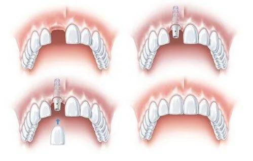 cay ghep implant an toan tai nha khoa Viet uc 2 cay ghep implant an toan tai nha khoa Viet uc 2