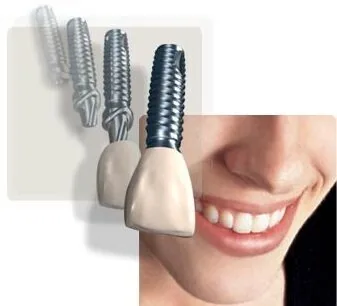 cay ghep implant an toan tai nha khoa Viet uc 4 cay ghep implant an toan tai nha khoa Viet uc 4