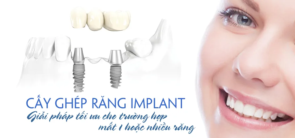 cay ghep implant an toan tai nha khoa Viet uc cay ghep implant an toan tai nha khoa Viet uc
