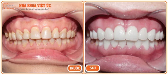 Bọc răng sứ là gì? Kết quả bọc răng sứ như thế nào? Bọc răng sứ là gì? Kết quả bọc răng sứ như thế nào?