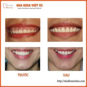 Kết quả sau khi khắc phục cười hở lợi tại Nha Khoa Việt Úc