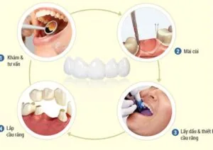bọc răng sứ bao nhiêu tiền