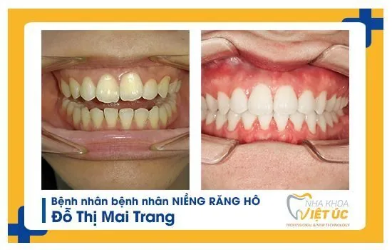 Hình ảnh trước - sau khi niềng răng hô