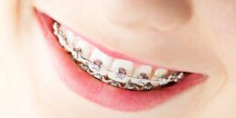 Niềng răng bao nhiêu tiền và thời gian niềng răng mất bao lâu?