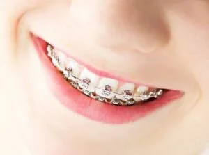 Niềng răng bao nhiêu tiền và thời gian niềng răng mất bao lâu