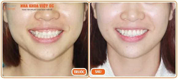 Thẩm mỹ cười hở lợi hiệu quả nhanh chóng