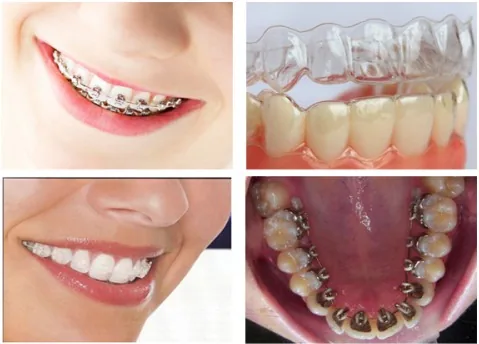 Các loại niềng răng giá bao nhiêu