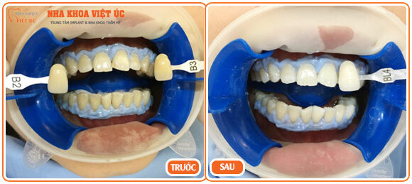 Hình ảnh bệnh nhân trước và sau khi tẩy trắng răng