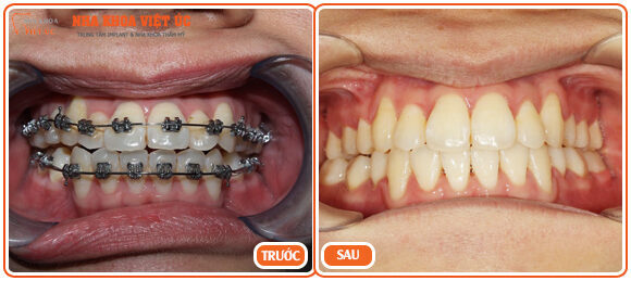 Hình ảnh bệnh nhân niềng răng tại nha khoa Việt Úc