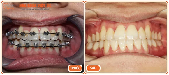giá niềng răng của các loại mắc cài