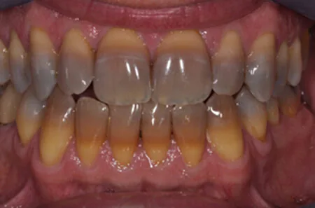 Răng nhiễm tetracylin có nên tẩy trắng răng không?