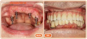 làm răng Implant