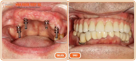Hình ảnh bệnh nhân trước và sau khi trồng răng Implant All On 4 trong rang Implant