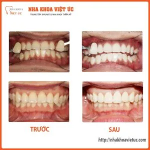 Địa chỉ tẩy trắng răng giá rẻ tại Hà Nội