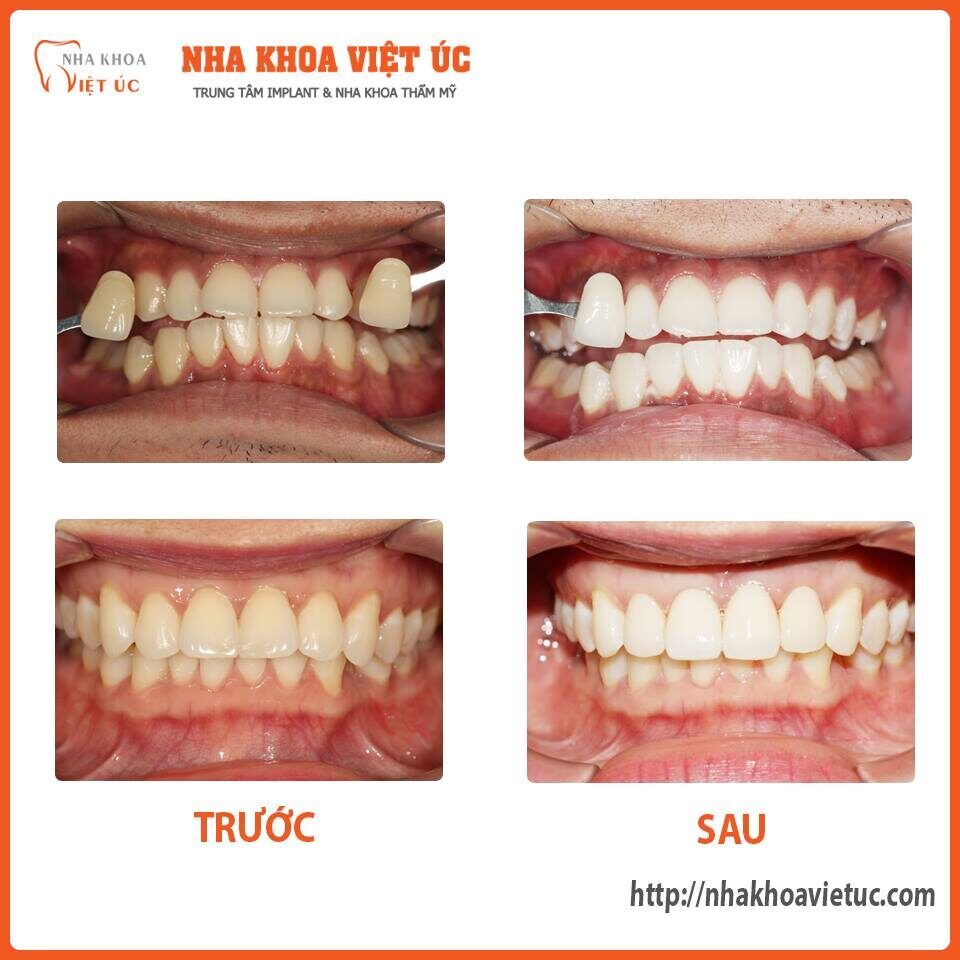 Kết quả tẩy trắng răng tại NKVU