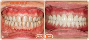 Hình ảnh bệnh nhân sau khi bọc răng sứ tại nha khoa Việt Úc