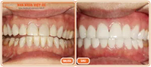 Bọc răng sứ Cercon giá bao nhiêu?
