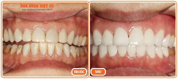 Bọc răng sứ Cercon giá bao nhiêu?