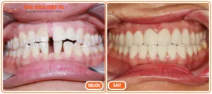 Bọc răng sứ Cercon chính là giải pháp hoàn hảo để khắc phục khuyết điểm răng thưa Làm răng sứ cho răng thưa