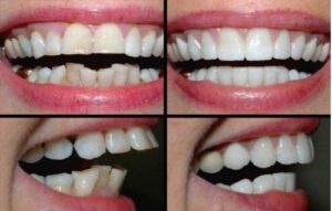Hình ảnh bệnh nhân trước và sau khi bọc răng sứ chữa hô