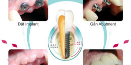 Quy trình làm răng Implant an toàn, chính xác và hiệu quả cao