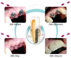 làm răng implant 2