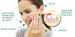 Nhổ răng số 8 an toàn – Nhanh chóng – Không đau nhức