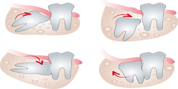 Nhổ răng số 8 mọc ở nhiều vị trí khác nhau