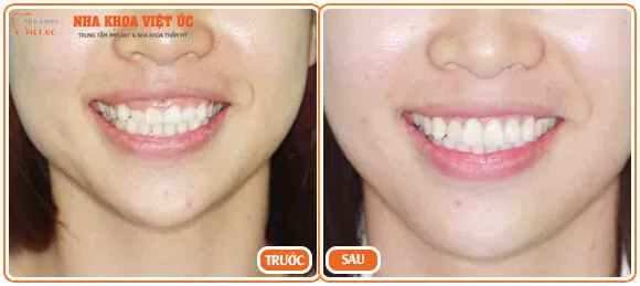Bệnh nhân trước và sau chữa cười hở lợi