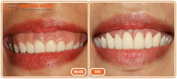 Bệnh nhân trước và sau khi điều trị cười hở lợi