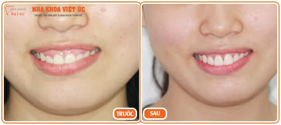 Bệnh nhân trước và sau chữa cười hở lợi