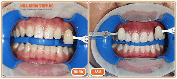 Bệnh nhân trước và sau tẩy trắng răng