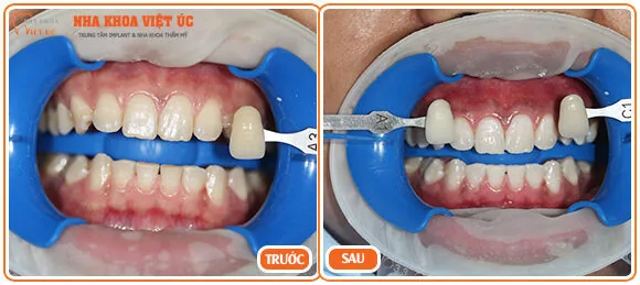 Tẩy trắng răng ở đâu tốt nhất Hà Nội - Nha Khoa Việt Úc