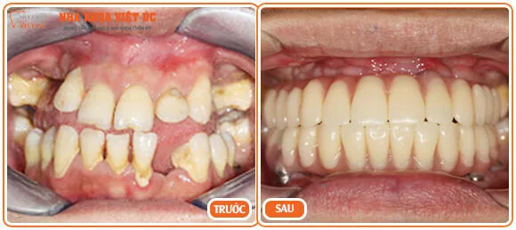 Trồng răng Implant có đau không trong rang Implant co dau khong