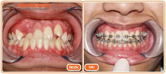 Răng khấp khểnh có niềng răng được không Răng khấp khểnh có niềng răng được không
