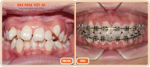 Răng khấp khểnh có niềng răng được không Răng khấp khểnh có niềng răng được không