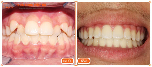 Hình ảnh BN Lân trước và sau khi niềng răng thẩm mỹ