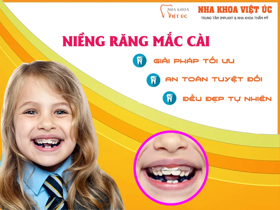 Nên niềng răng cho trẻ em sớm để hiệu quả cao Nên niềng răng cho trẻ em sớm để hiệu quả cao
