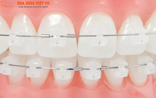 nieng-rang-mac-cai-su-tai-nha-khoa-viet-uc