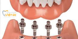 Trồng răng Implant có đau không, có nguy hiểm không?