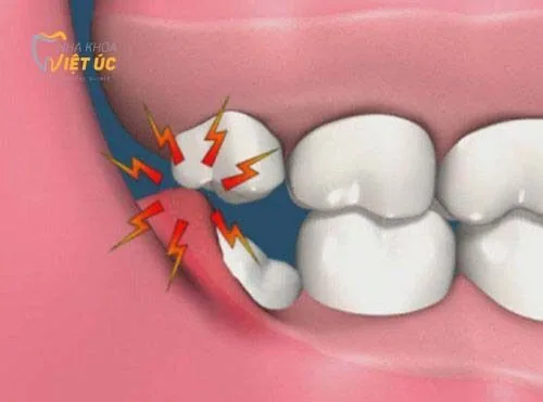 Có nên nhổ răng khôn khi mang thai không? 1
