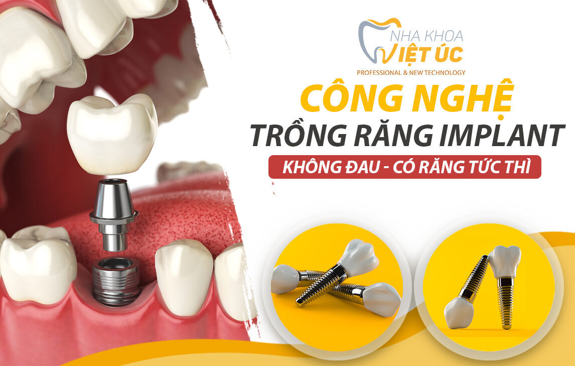 trong rang Implant All on 4 - All on 6